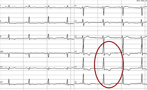 HOCM EKG